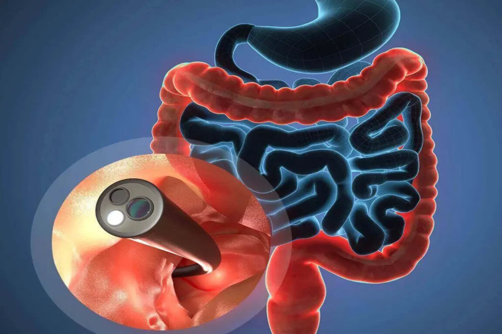 colonoscopy
