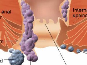 পাইলস বা হেমোরয়েড: কারণ, লক্ষণ, প্রতিকার ও আধুনিক চিকিৎসা পাইলস বা হেমোরয়েড কী?